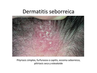 Dermatitis seborreica
Pityriasis simplex, furfuracea o capitis, eccema seborreico,
pitiriasis seca y esteatoide
 