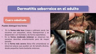 Pueden distinguir tres forma:
• En la forma más leve (caspa o pitiriasis seca), las
escamas son pequeñas, secas, blanquecinas y se
desprenden con facilidad y de forma espontánea.
• En la forma moderada (clásica) se observan las
escamas descritas anteriormente pero de mayor
tamaño.
• En la forma más severa (falsa tiña amiantácea) se
observan placas que pueden ser de tamaño diverso,
desde pequeñas hasta bastante extensas.
Dermatitis seborreica en el adulto
Cuero cabelludo
 