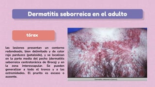 las lesiones presentan un contorno
redondeado, bien delimitado y de color
rojo parduzco (petaloide), y se localizan
en la parte media del pecho (dermatitis
seborreica centrotorácica de Brocq) y en
la zona interescapular. Se pueden
generalizar a todo el tronco y a las
extremidades. El prurito es escaso o
ausente.
Dermatitis seborreica en el adulto
tórax
 