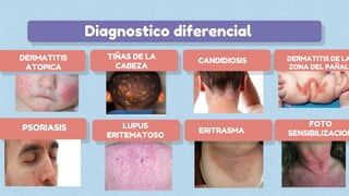 TIÑAS DE LA
CABEZA
Diagnostico diferencial
DERMATITIS
ATOPICA
CANDIDIOSIS
PSORIASIS LUPUS
ERITEMATOSO
DERMATITIS DE LA
ZONA DEL PAÑAL
FOTO
SENSIBILIZACION
ERITRASMA
 