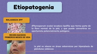 Etiopatogenia
MALASSEZIA SPP
RECIEN NACIDOS
PRIMEROS MESES DE VIDA
la piel es oleosa en áreas seborreicas por hiperplasia de
glándulas sebáceas
(Pityrosporum ovale) levadura lipófila que forma parte de
la flora normal de la piel, y que puede convertirse en
oportunista potencialmente patógeno
 