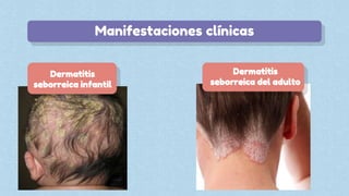 Manifestaciones clínicas
Dermatitis
seborreica infantil
Dermatitis
seborreica del adulto
 