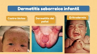 Costra láctea Dermatitis del
pañal
Eritrodermia
Dermatitis seborreica infantil
 