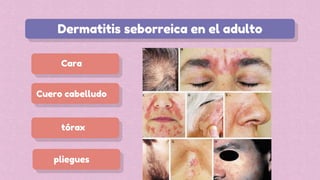 Cara
Dermatitis seborreica en el adulto
tórax
Cuero cabelludo
pliegues
 
