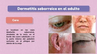 se localizan en las cejas
(blefaritis seborreica),
alrededor de la nariz, en el
borde del cuero cabelludo y en
la parte interna del pabellón
auricular, en el pliegue por
detrás de la oreja
Cara
Dermatitis seborreica en el adulto
 