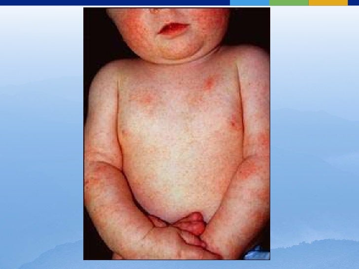 La psoriasis por el cuero cabelludo