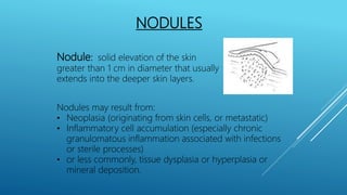 NODULES
Nodule: solid elevation of the skin
greater than 1 cm in diameter that usually
extends into the deeper skin layers.
Nodules may result from:
• Neoplasia (originating from skin cells, or metastatic)
• Inflammatory cell accumulation (especially chronic
granulomatous inflammation associated with infections
or sterile processes)
• or less commonly, tissue dysplasia or hyperplasia or
mineral deposition.
 