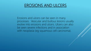 EROSIONS AND ULCERS
Erosions and ulcers can be seen in many
processes. Vesicular and bullous lesions usually
evolve into erosions and ulcers. Ulcers can also
be seen severe infections and in association
with neoplasia (eg squamous cell carcinoma).
 