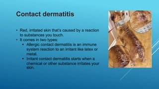 Contact dermatitis
• Red, irritated skin that’s caused by a reaction
to substances you touch.
• It comes in two types:
 Allergic contact dermatitis is an immune
system reaction to an irritant like latex or
metal.
 Irritant contact dermatitis starts when a
chemical or other substance irritates your
skin.
 