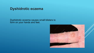 Dyshidrotic eczema
Dyshidrotic eczema causes small blisters to
form on your hands and feet.
 