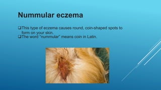 Nummular eczema
This type of eczema causes round, coin-shaped spots to
form on your skin.
The word “nummular” means coin in Latin.
 