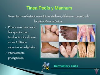 Tinea Pedís y Mannum 
Presentan manifestaciones clínicas similares, difieren en cuanto a la 
localización anatómica. 
Dermatitis y Tiñas 
ü Provocan un macerado 
blanquecino con 
tendencia a localizarse 
en los 2 últimos 
espacios interdigitales. 
ü Intensamente 
pruriginosas. 
ANDRES AGUILAR 
 