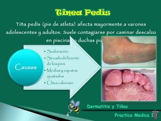 Dermatitis y Tiñas Practica Medica I Tiña pedís (pie de atleta) afecta mayormente a varones adolescentes y adultos. Suele contagiarse por caminar descalzo en piscinas o duchas publicas 