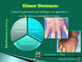 Dermatitis y Tiñas Practica Medica I Común en personas que trabajan con guantes o con las manos sumergidas en agua 