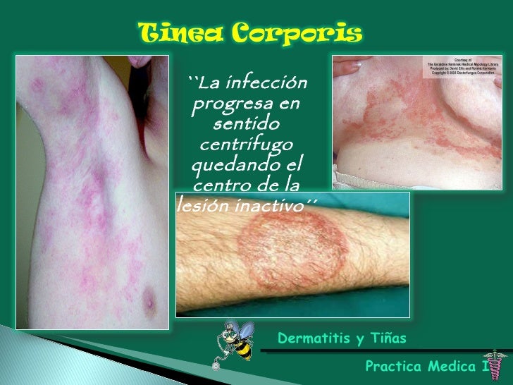 Dermatitis y tineas