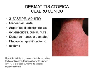 DERMATITIS ATOPICA
CUADRO CLINICO
• 3. FASE DEL ADULTO.
• Menos frecuente
• Superficie de flexión de las
• extremidades, cuello, nuca,
• Dorso de manos o genitales
• Placas de liquenificacion o
• eccema
El prurito es intenso, a veces paroxístico, sobre
todo por la noche. Cuando el prurito es muy
severo, la piel seca aumenta de espesor,
liquenificándose.
 