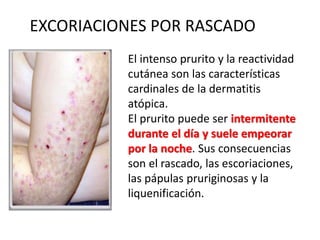 EXCORIACIONES POR RASCADO
El intenso prurito y la reactividad
cutánea son las características
cardinales de la dermatitis
atópica.
El prurito puede ser intermitente
durante el día y suele empeorar
por la noche. Sus consecuencias
son el rascado, las escoriaciones,
las pápulas pruriginosas y la
liquenificación.
 