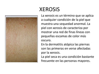 XEROSIS
La xerosis es un término que se aplica
a cualquier condición de la piel que
muestra una sequedad anormal. La
piel con xerosis de caracteriza por
mostrar una red de finas líneas con
pequeñas escamas de color más
oscuro.
En la dermatitis atópica las piernas
son las primeras en verse afectadas
por la xerosis.
La piel seca es una condición bastante
frecuente en las personas mayores.
 