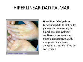 HIPERLINEARIDAD PALMAR
Hiperlinearidad palmar
La sequedad de la piel en las
palmas de las manos y la
hiperlinealidad palmar
confieren a las manos el
mismo aspecto que las de
una persona anciana,
aunque se trate de niños de
corta edad.
 