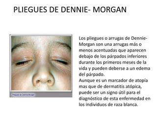 PLIEGUES DE DENNIE- MORGAN
Los pliegues o arrugas de Dennie-
Morgan son una arrugas más o
menos acentuadas que aparecen
debajo de los párpados inferiores
durante los primeros meses de la
vida y pueden deberse a un edema
del párpado.
Aunque es un marcador de atopía
mas que de dermatitis atópica,
puede ser un signo útil para el
diagnóstico de esta enfermedad en
los individuos de raza blanca.
 