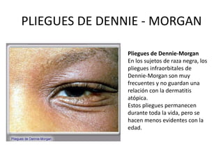 PLIEGUES DE DENNIE - MORGAN
Pliegues de Dennie-Morgan
En los sujetos de raza negra, los
pliegues infraorbitales de
Dennie-Morgan son muy
frecuentes y no guardan una
relación con la dermatitis
atópica.
Estos pliegues permanecen
durante toda la vida, pero se
hacen menos evidentes con la
edad.
 