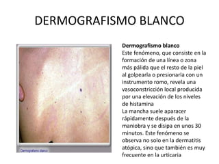 DERMOGRAFISMO BLANCO
Dermografismo blanco
Este fenómeno, que consiste en la
formación de una línea o zona
más pálida que el resto de la piel
al golpearla o presionarla con un
instrumento romo, revela una
vasoconstricción local producida
por una elevación de los niveles
de histamina
La mancha suele aparacer
rápidamente después de la
maniobra y se disipa en unos 30
minutos. Este fenómeno se
observa no solo en la dermatitis
atópica, sino que también es muy
frecuente en la urticaria
 