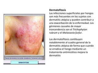 Dermatofitosis
Las infecciones superficiales por hongos
son más frecuentes en los sujetos con
dermatitis atópica y pueden contribuir a
una exacerbación de la enfermedad. Los
gérmenes causales de mayor
trancendencia son el Trichophyton
rubrum y el Malassezia furfur.
Las dermatofitosis contibuyen
notablemente al cuadro general de la
dermatitis atópica de forma que cuando
se erradica el hongo mediante un
tratamiento antimicótico mejora la
dermatitis
 