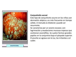 Conjuntivitis vernal
Este tipo de conjuntivitis ocurre en los niños con
dermatitis atópica y es más frecuente en tiempo
cálido. A menudo es bilateral y puede ser
recurrente.
Se caracteriza por un severo escozor, con
lagrimación y exudaciones mucosas espesas que
contienen eosinófilos. Se suelen formar grandes
papilas en la conjuntiva bajo el párpado superior.
El prurito se agrava con la luz, los irritantes o el
sudor.
 