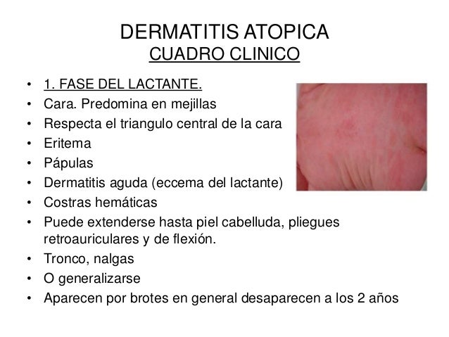 Que dar de comer al niño de 8 meses con atopicheskim por la dermatitis