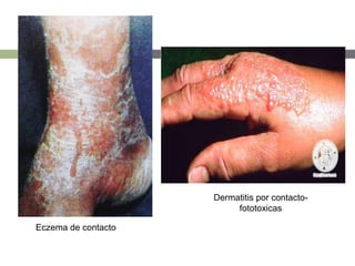 Dermatitis por contacto-
fototoxicas
Eczema de contacto
 