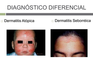 DIAGNÓSTICO DIFERENCIAL
 Dermatitis Atópica  Dermatitis Seborréica
 