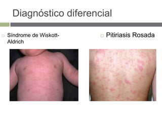 Diagnóstico diferencial
 Síndrome de Wiskott-
Aldrich
 Pitiriasis Rosada
 