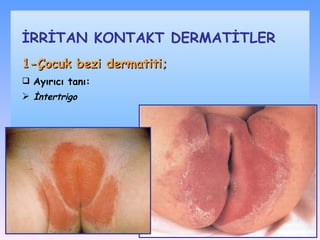 1-Çocuk bezi dermatiti;   Ayırıcı tanı : İ ntertrigo İRRİTAN KONTAKT DѴİLER 