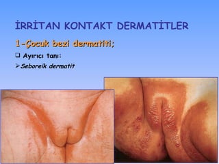 1-Çocuk bezi dermatiti;   Ayırıcı tanı : S eboreik dermatit İRRİTAN KONTAKT DѴİLER 