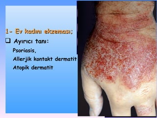 1-  Ev kadını ekzeması ;   Ayırıcı tanı : P soriasis,  A llerjik kontakt dermatit A topik dermatit 