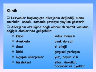 Lezyonlar başlangıçta allerjenin değindiği alana sınırlıdır; ancak, zamanla çevreye yayılım gösterir. Allerjenin özelliğine bağlı olarak dermatit vücudun değişik alanlarında gelişebilir ;   Küpe kulak memesi A yakkabı ayak dorsali S aat el bileği Bitki çizgisel yerleşim U çuşan allerjen le r yüz, boyun V’si Mesleksel eller ,  önkollar ,   bacaklar ve ayaklar Klinik 