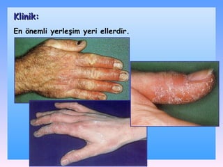 En önemli yerleşim yeri ellerdir. Klinik: 