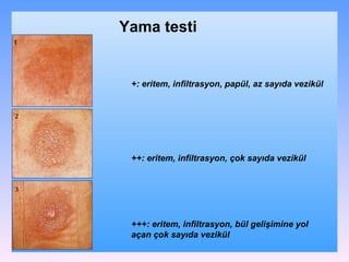 Yama testi +: eritem, infiltrasyon, papül, az sayıda vezikül ++: eritem, infiltrasyon, çok sayıda vezikül +++: eritem, infiltrasyon, bül gelişimine yol açan çok sayıda vezikül 