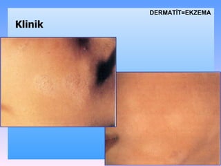 DѴİ=EKZEMA Klinik 