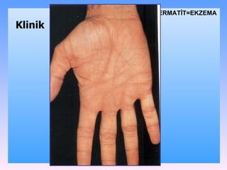 DѴİ=EKZEMA Klinik 