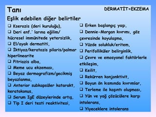 K serozis (deri kurulu ğ u),  D eri enf .’  lar ı na e ğ ilim/   hücresel immünitede yetersizlik,  E l/ayak dermatiti, İ ktiyoz/keratozis pilaris/palmar hiperlinearite P itriazis alba,  M eme ucu ekzemas ı ,  B eyaz dermografizm/gecikmi ş  beyazlanma,  A nterior subkapsüler katarakt, keratokonus,  S erum IgE düzeylerinde art ış , T ip I deri testi reaktivitesi,   E ş lik edebilen di ğ er belirtiler E rken ba ş lang ı ç ya şı , Dennie-Morgan kıvrımı, göz çevresinde koyulaşma,   Y üzde solukluk/eritem, P erifolliküler belirginlik, Ç evre ve emosyonel faktörlerle etkileşim,  K eilit,  R ekürren konjonktivit, B oyun ön k ı sm ı nda k ı vr ı mlar, T erleme ile ka şı nt ı  olu ş mas ı , Y ün ve ya ğ  çözücülere kar şı  intolerans,  Y iyeceklere intolerans DѴİ=EKZEMA Tanı 