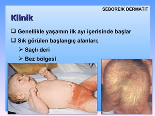 G enellikle yaşamın ilk ayı içerisinde  başlar Sık  görülen başlangıç alanları ; Saçlı deri B ez bölgesi Klinik SEBOREİK DѴİ 