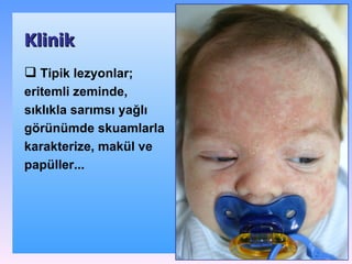 Klinik SEBOREİK DѴİ Tipik lezyonlar ;  eritemli zeminde, sıklıkla sarımsı yağlı görünümde skuamlarla karakterize, makül ve papüller .. . 