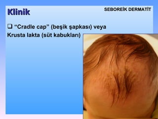 Klinik SEBOREİK DѴİ “ Cradle cap” (beşik şapkası) ve ya K rusta lakta (süt kabukları) 