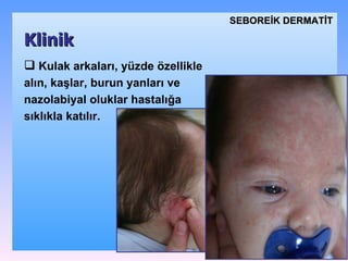 K ulak arkaları, yüzde özellikle alın, kaşlar, burun yanları ve nazolabiyal oluklar hastalığa  sıklıkla  katılır.  Klinik SEBOREİK DѴİ 
