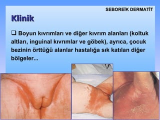 Boyun kıvrımları ve diğer kıvrım alanları (koltuk altları, inguinal kıvrımlar ve göbek) ,   a yrıca, çocuk bezinin örttüğü alanlar hastalığa sık katılan  diğer  bölgeler .. . Klinik SEBOREİK DѴİ 