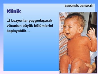 L ezyonlar yaygınlaşarak vücudun büyük bölümlerini kaplayabilir … Klinik SEBOREİK DѴİ 
