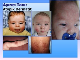 Ayırıcı Tanı: Atopik Dermatit 