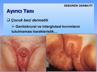 Çocuk bezi dermatiti G enitokrural ve intergluteal kıvrımların tutulmaması karakteristik …   Ayırıcı Tanı SEBOREİK DѴİ 