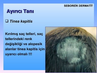 T inea kapitis Kırılmış saç telleri, saç tellerindeki renk değişikliği  ve  alopesi k alanlar  tinea kapitis için uyarıcı olmalı  !!! Ayırıcı Tanı SEBOREİK DѴİ 